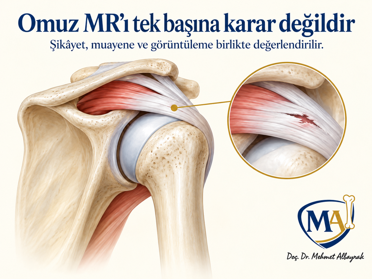 Parsiyel Rotator Cuff Yırtığı Nedir?